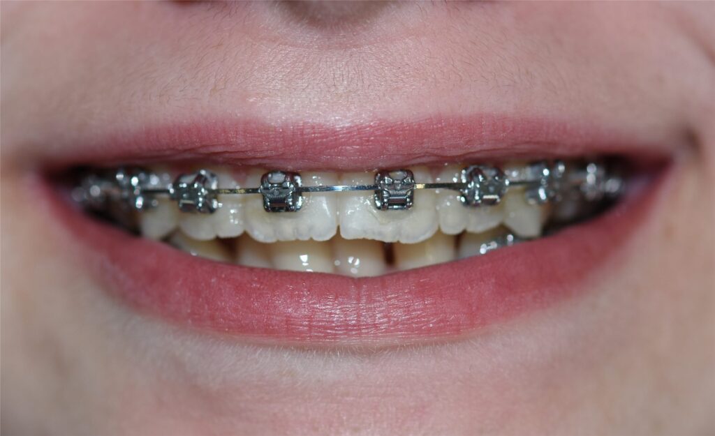 Brackets metálicos