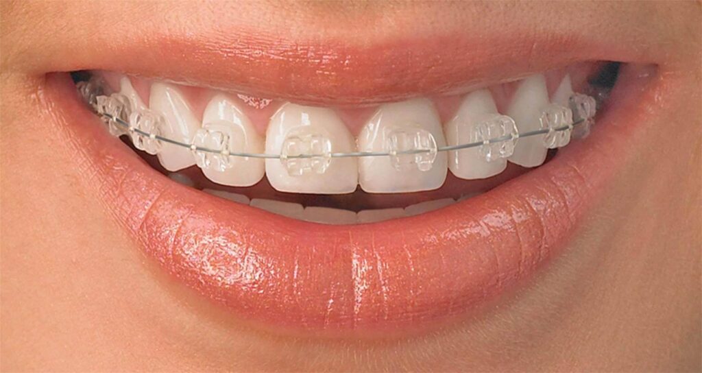 Brackets transparentes de zafiro