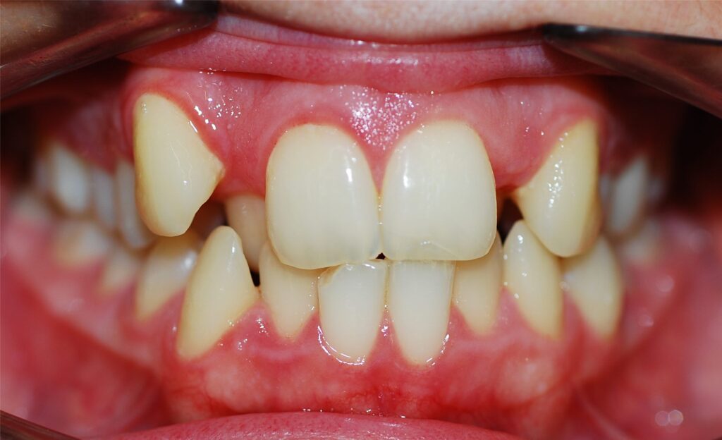 Caso de apiñamiento dental