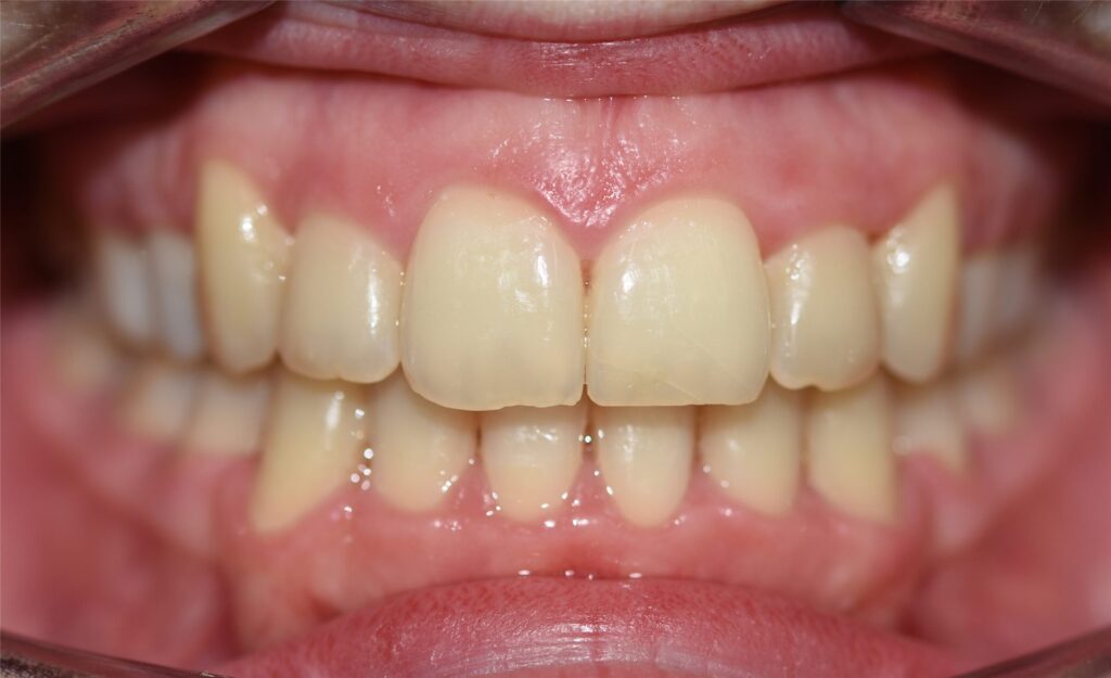 Caso de apiñamiento dental