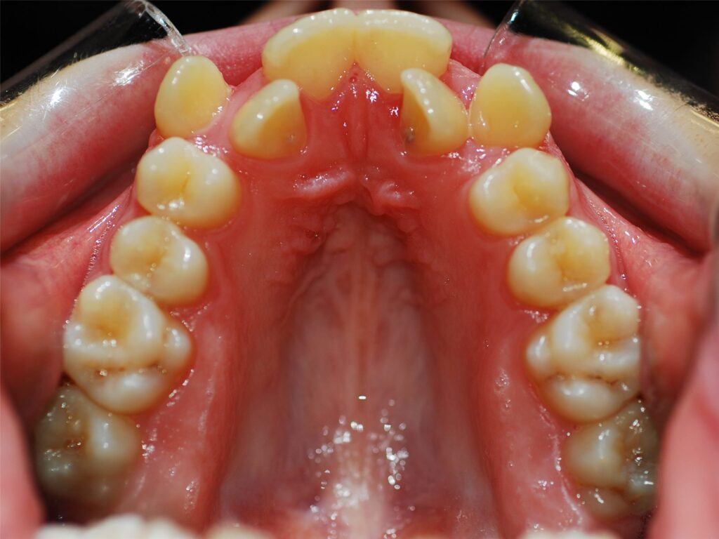 Caso de apiñamiento dental