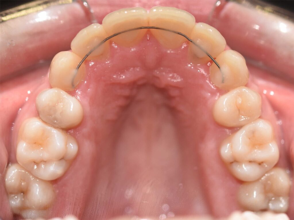 Caso de apiñamiento dental