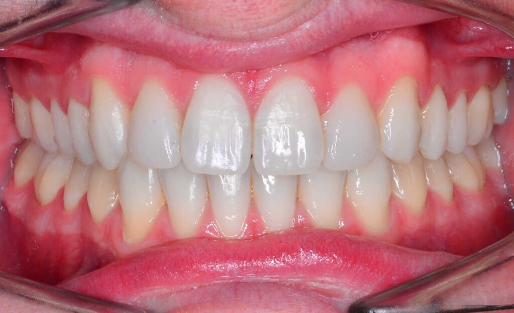 Caso de paladar estrecho y canino alto