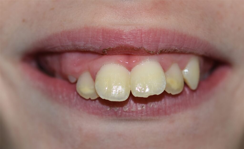 Caso de dientes protruidos (resalte)