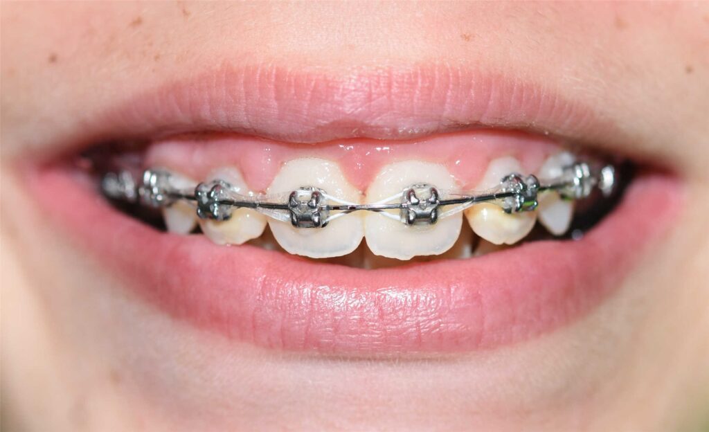 Caso de dientes protruidos (resalte)