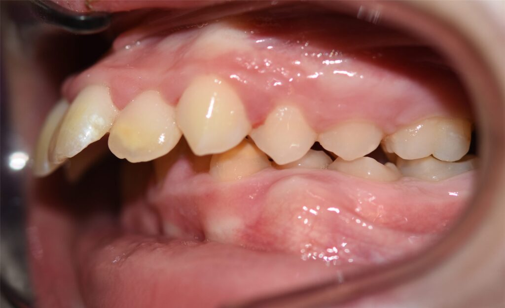 Caso de dientes protruidos (resalte)