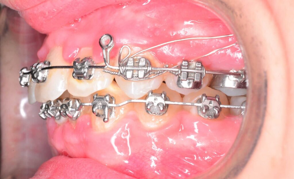 Caso de dientes protruidos (resalte)