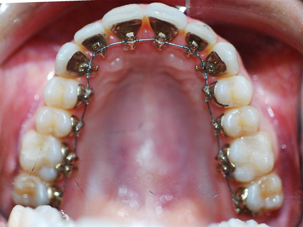 Brackets linguales en la cara interna de los dientes